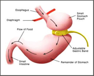 ntrance-hypnotherapy-blenheim-virtual-gastric-band